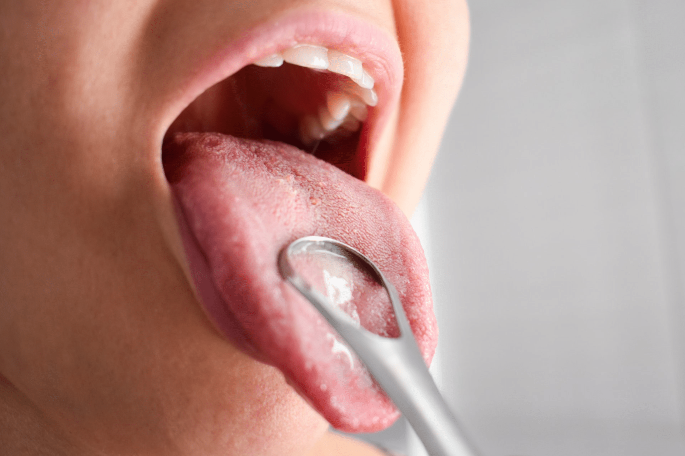 Las caries causan enfermedades fuera de la boca